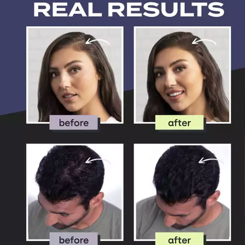 🔥HOT SALE 50% OFF🎁Hair Building Fibers Set for Thinning Hair & Bald Spots